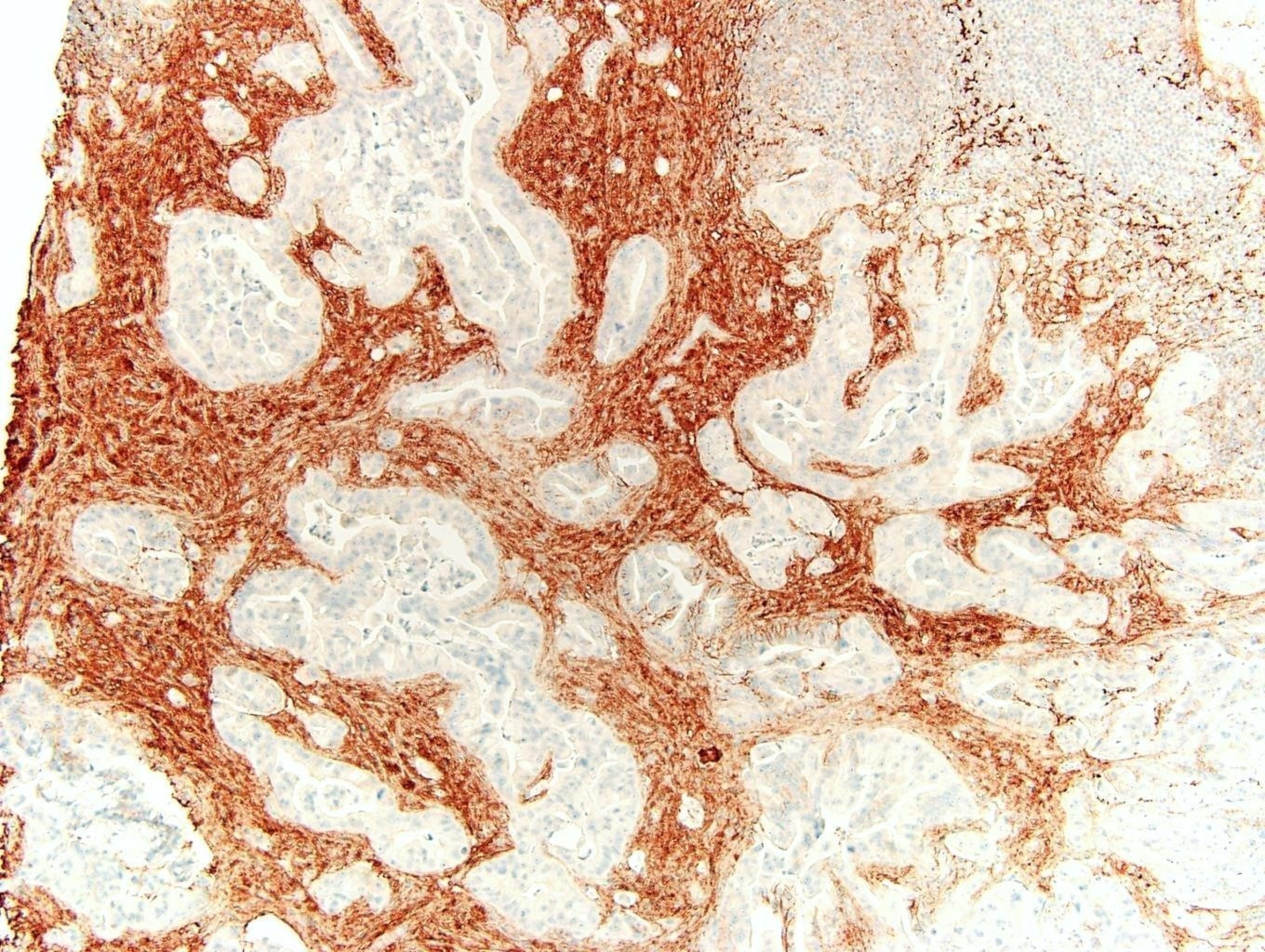 Hyaluronic Acid expressed in pancreatic cancer tissue at 40x magnification.