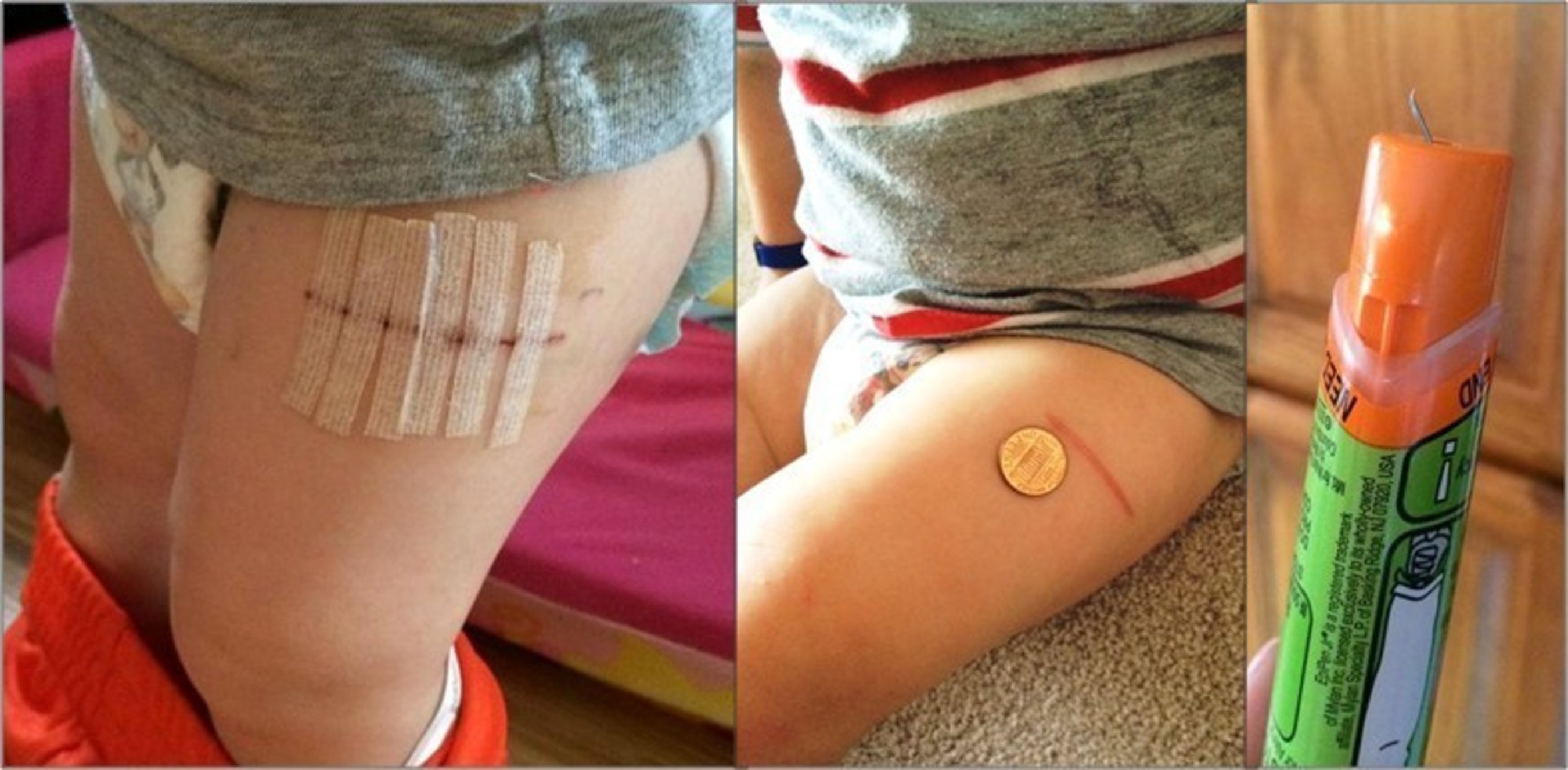 Epinephrine autoinjector injuries in children can be severe. Annals of Emergency Medicine