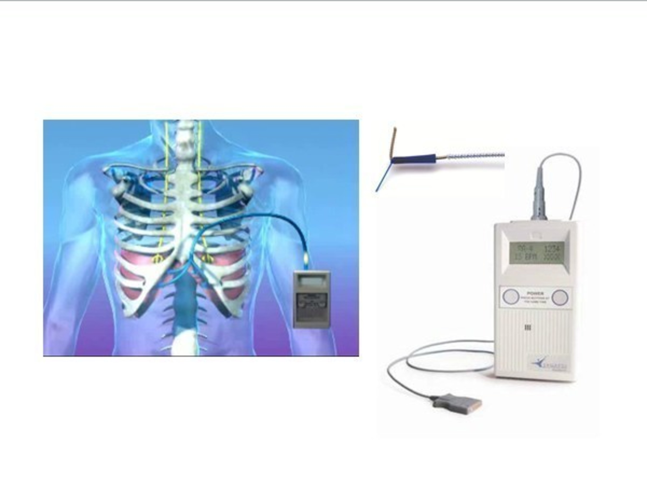 NeuRx Diaphragm Pacing System FDA approved for ALS patients with chronic hypoventilation and spinal cord injury (SCI) patients.