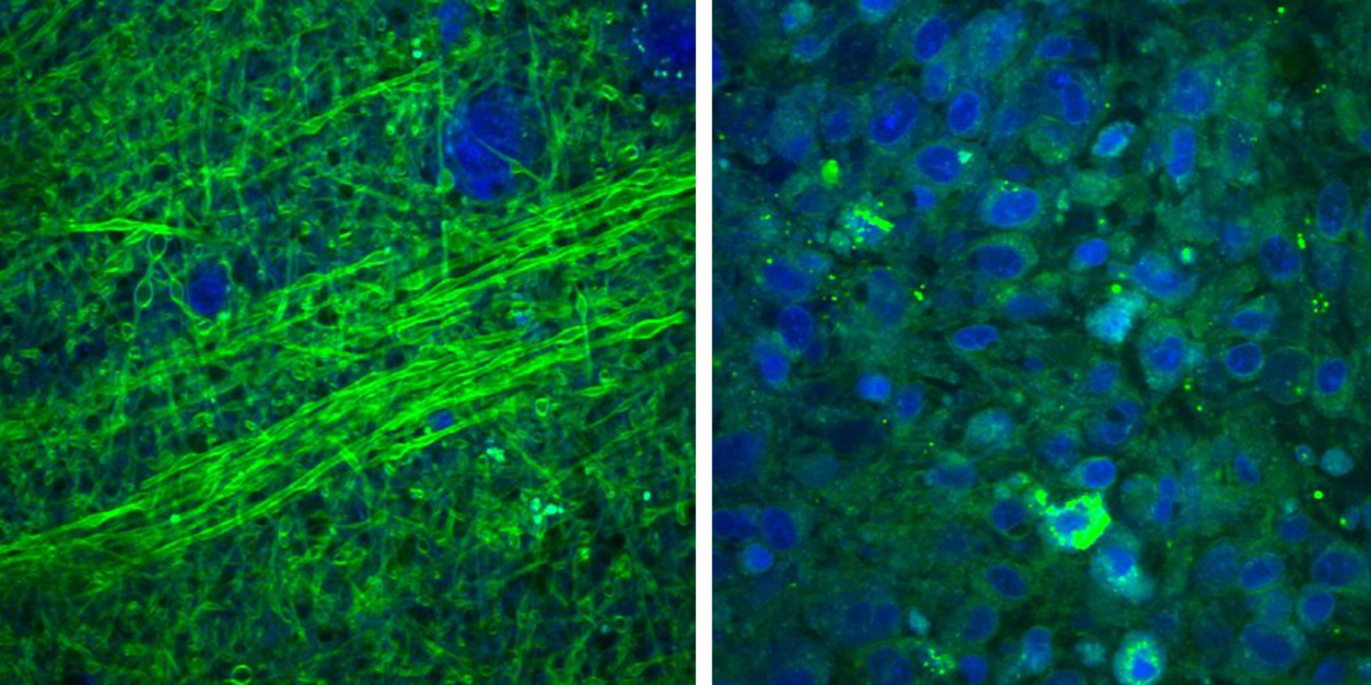 Images collected using an SRS microscope show that normal brain contains sparse cells with bundles of nerve fibers, called axons (left), but brain tumor tissue is full of cells in a disordered pattern (right). While you can see the difference on a microscopic scale, during surgery they'd be difficult to differentiate, making it hard for a surgeon to know where the tumor stops.