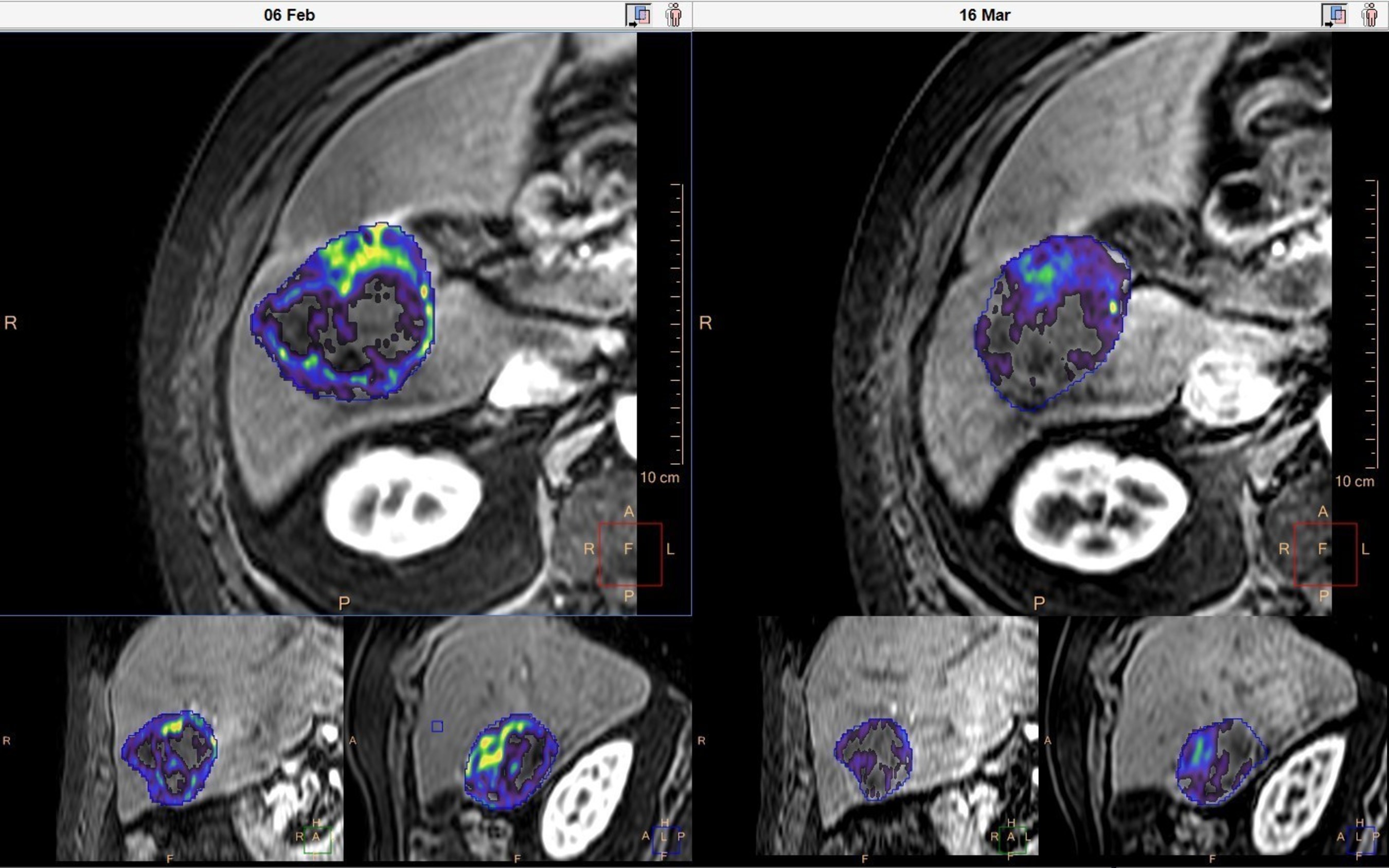 Quantitative tumor viability (qEASL*) before and after chemoembolization (TACE). Much of the viable tumor (colored) becomes less enhanced (transparent) after the treatment. Tumor viability percentage (represents the percentage of the entire tumor volume showing enhancement more than normal liver tissue), viability volume and total volume are automatically calculated. *For research use only