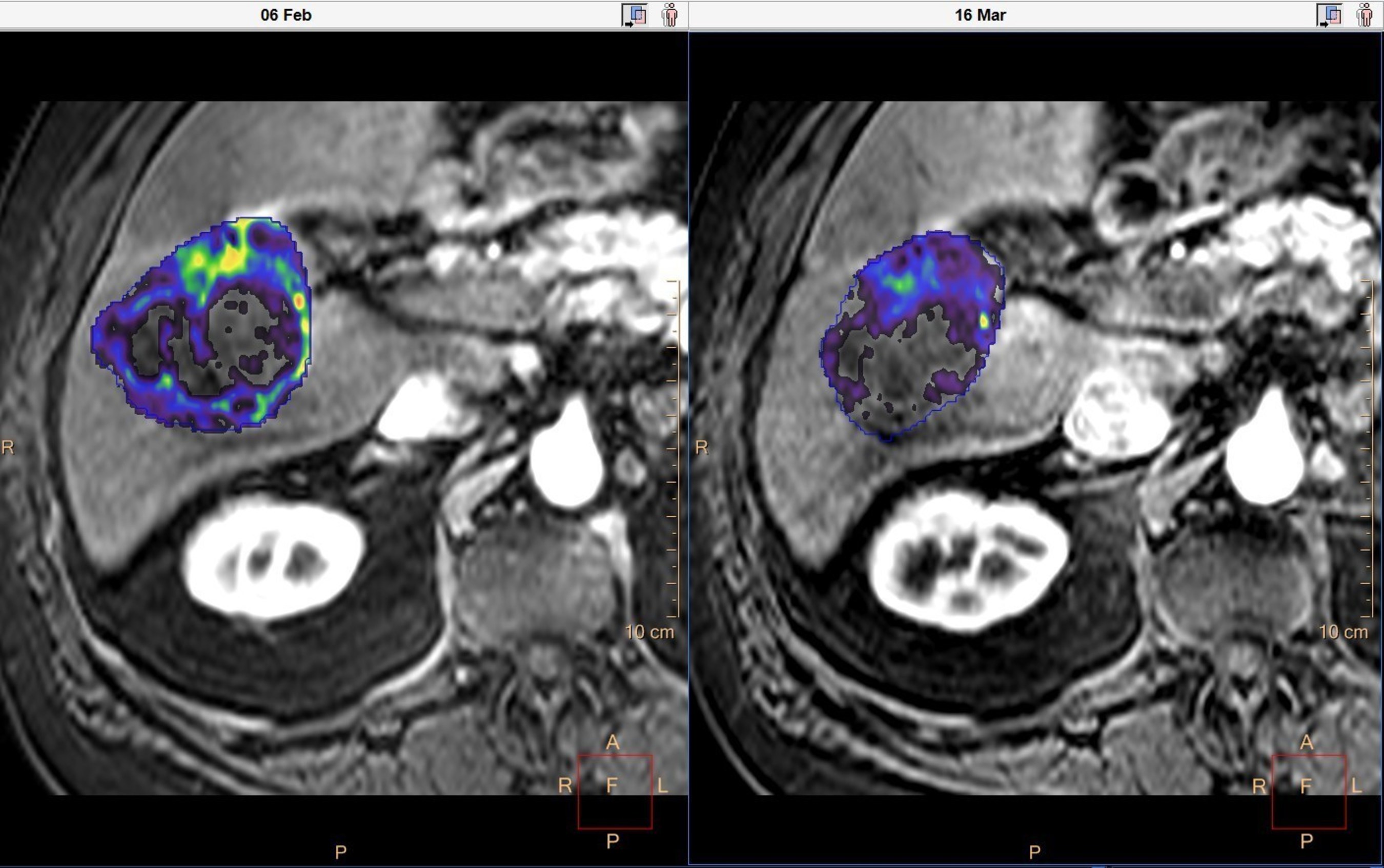 Quantitative tumor viability (qEASL*) before and after chemoembolization (TACE). Much of the viable tumor (colored) becomes less enhanced (transparent) after the treatment. Tumor viability percentage (represents the percentage of the entire tumor volume showing enhancement more than normal liver tissue), viability volume and total volume are automatically calculated. *For research use only