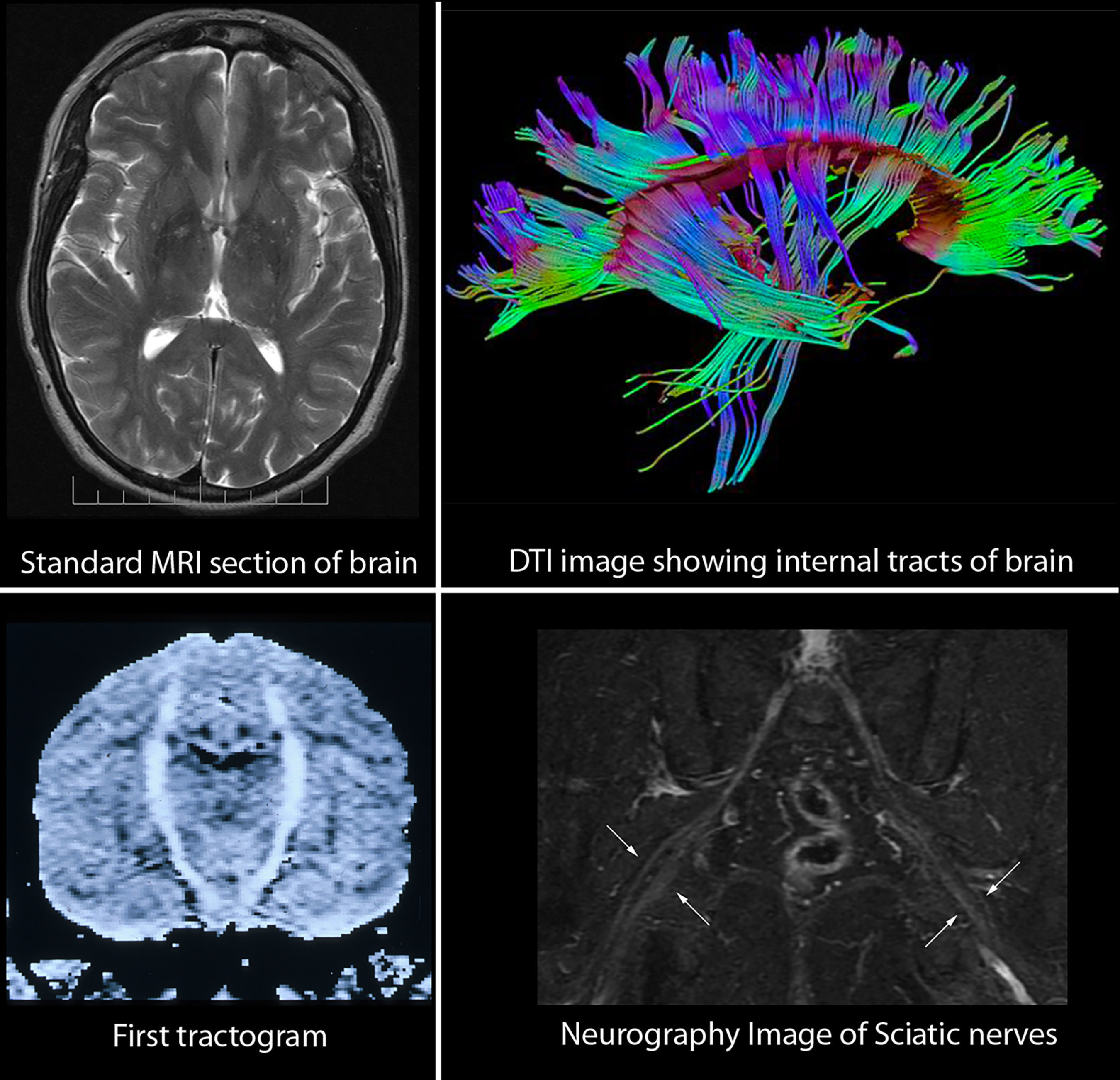 Comparison of standard brain MRI image with the three dimensional internal structure of the brain revealed by Diffusion Tensor Imaging (DTI). Brain injury from most impact sports, many civilian injuries, as well as those affecting war fighters are often invisible on standard MRI but are well seen on DTI. Dr. Aaron G. Filler was awarded the Pioneer in Medicine Award by the Society for Brain Mapping and Therapeutics for his invention of DTI.