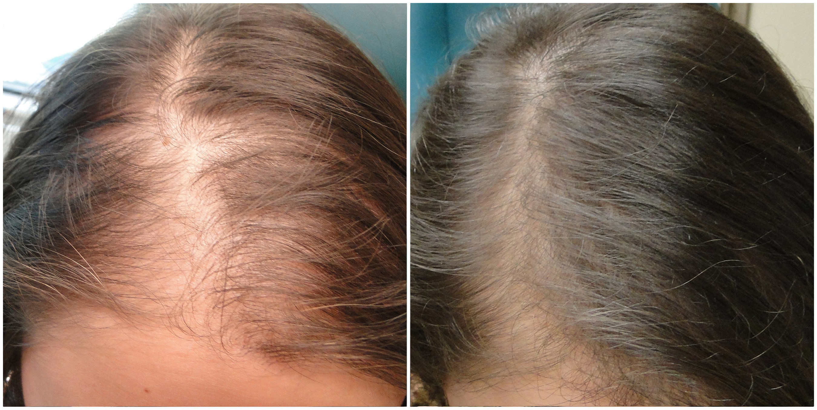 New Research Alert: PRP For Non Surgical Hair Restoration