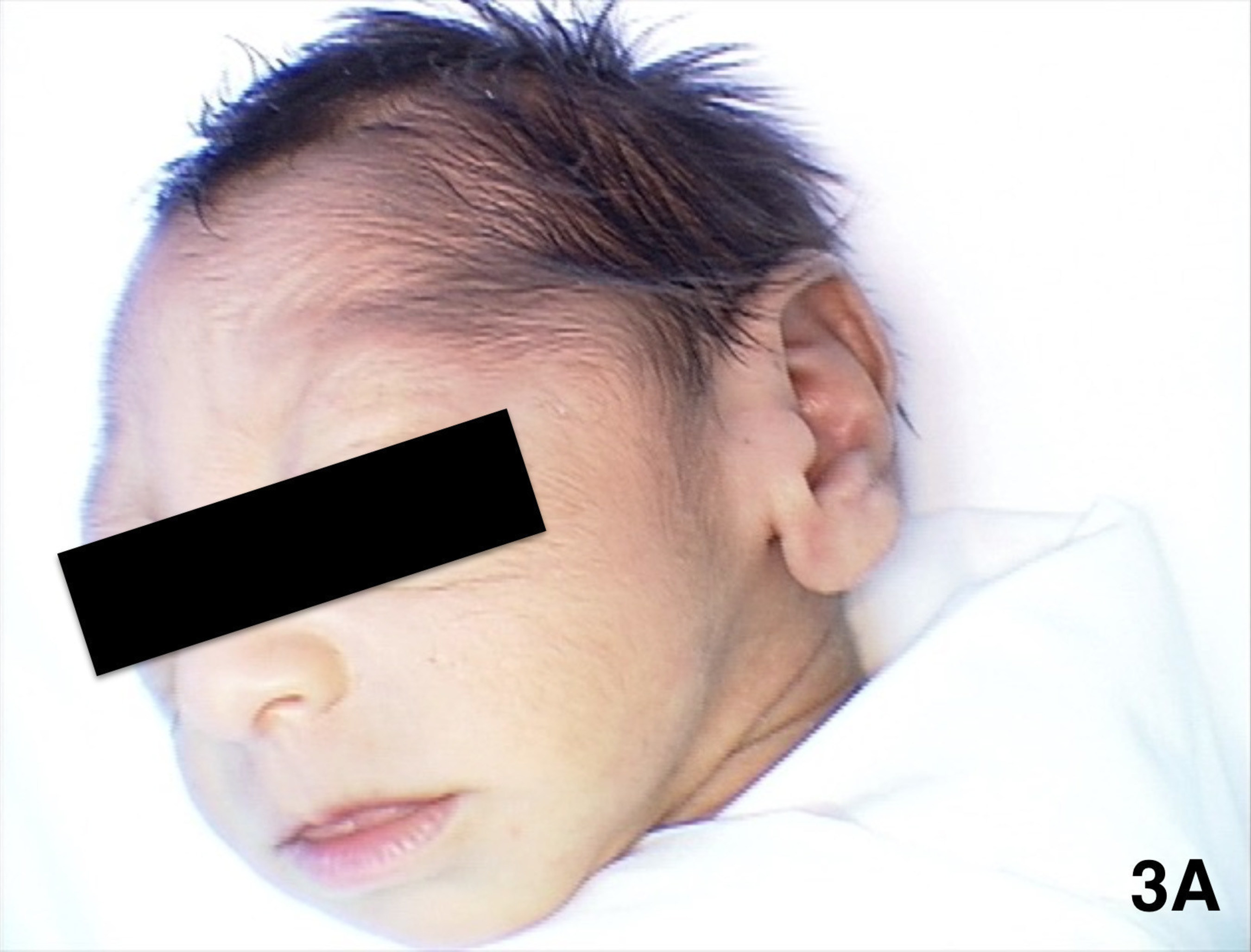 This infant has microcephaly presumed to be caused by the Zika virus. Researchers from Brazil and Stanford University recently found additional eye abnormalities in babies with Zika-induced microcephaly, according to a new study being published online May 25, 2016 in the journal Ophthalmology, journal of the American Academy of Ophthalmology.