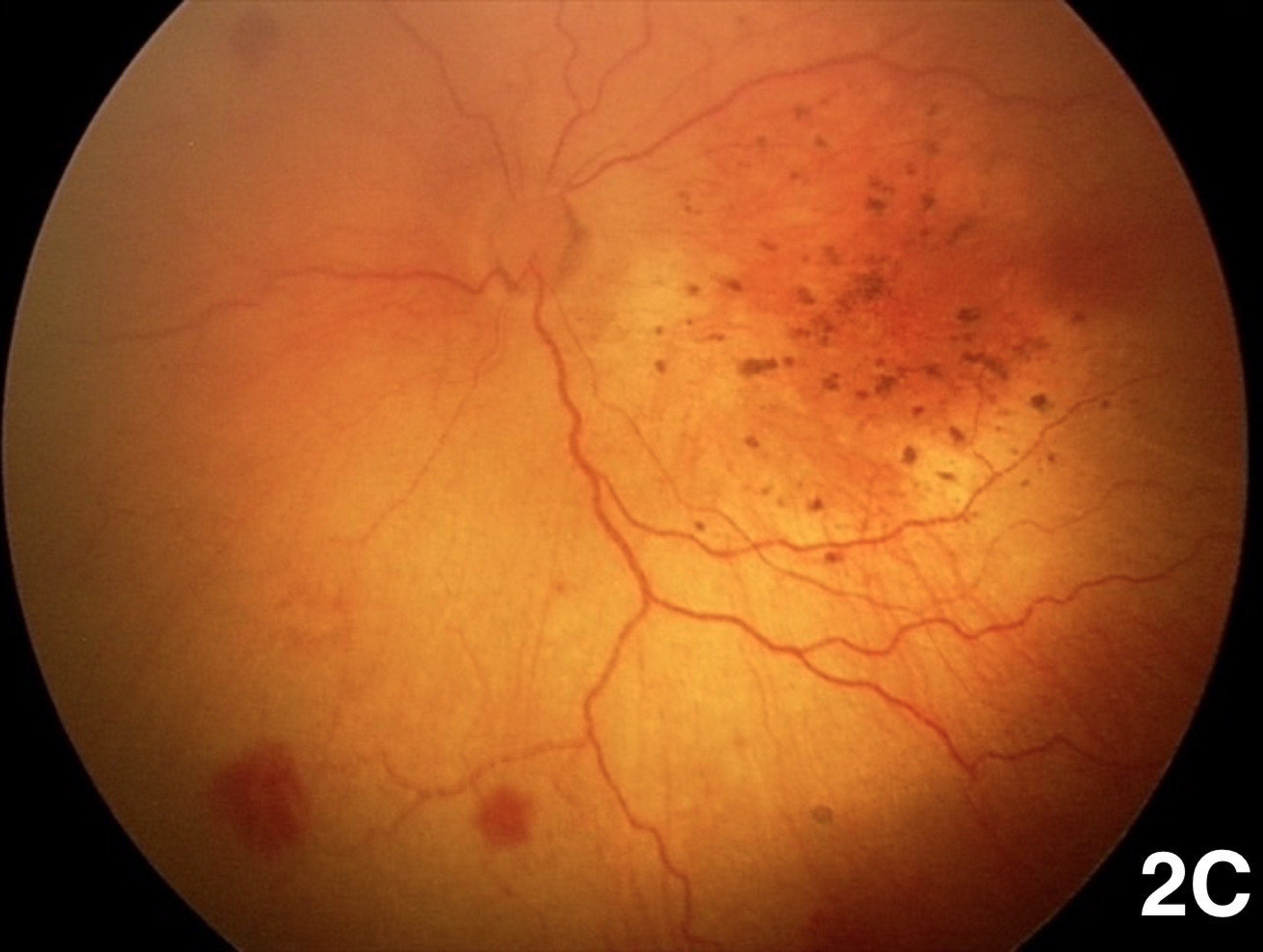 This image shows signs of retinal hemorrhaging in a baby with presumed Zika-induced microcephaly. Researchers from Brazil and Stanford University recently found additional eye abnormalities such as this in babies with Zika-induced microcephaly, according to a new study being published online May 25, 2016 in the journal Ophthalmology, journal of the American Academy of Ophthalmology.
