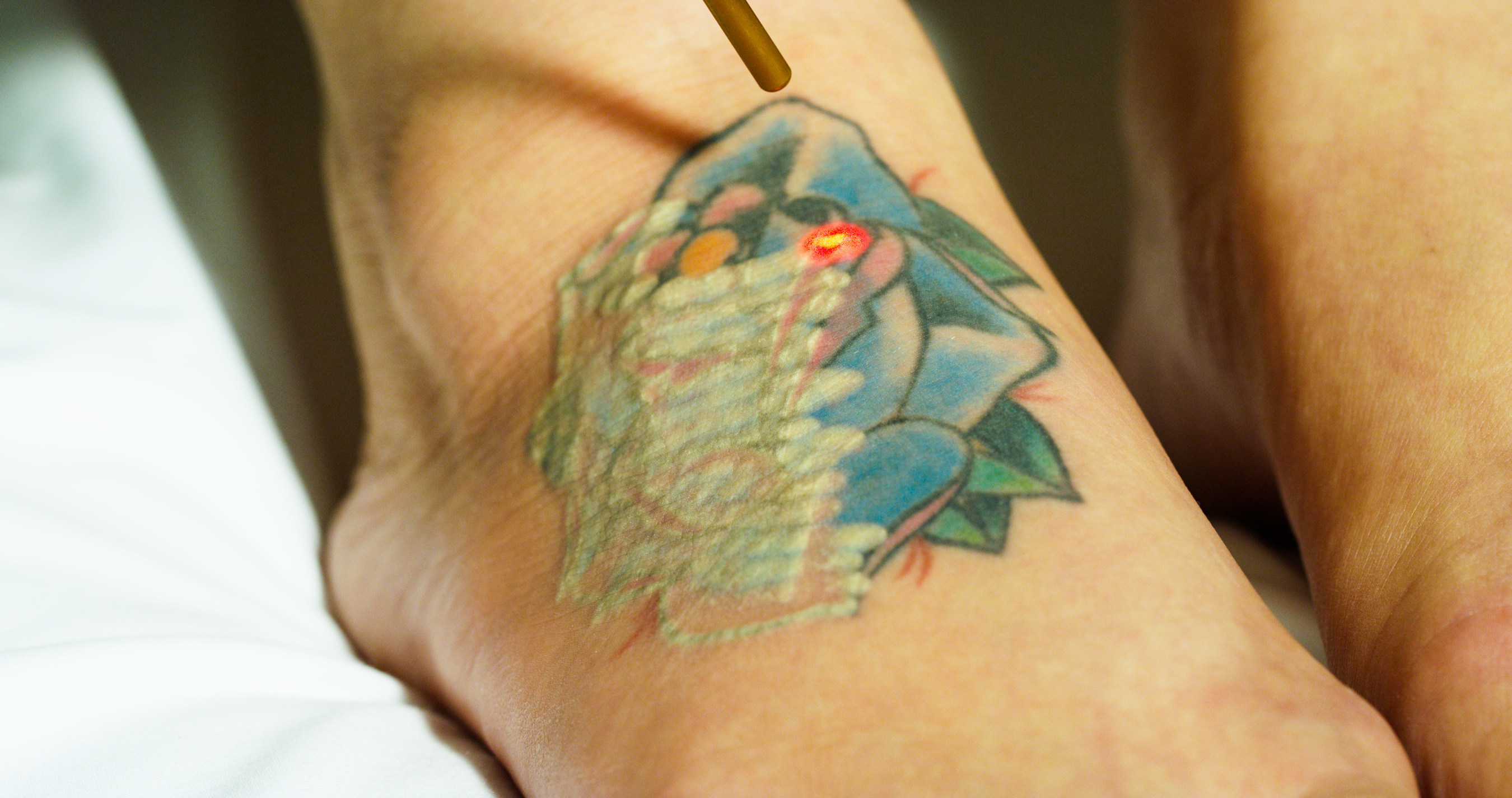 Eraser Clinic Brings Multi-Wavelength Astanza Trinity Laser Tattoo Removal  To Houston, TX