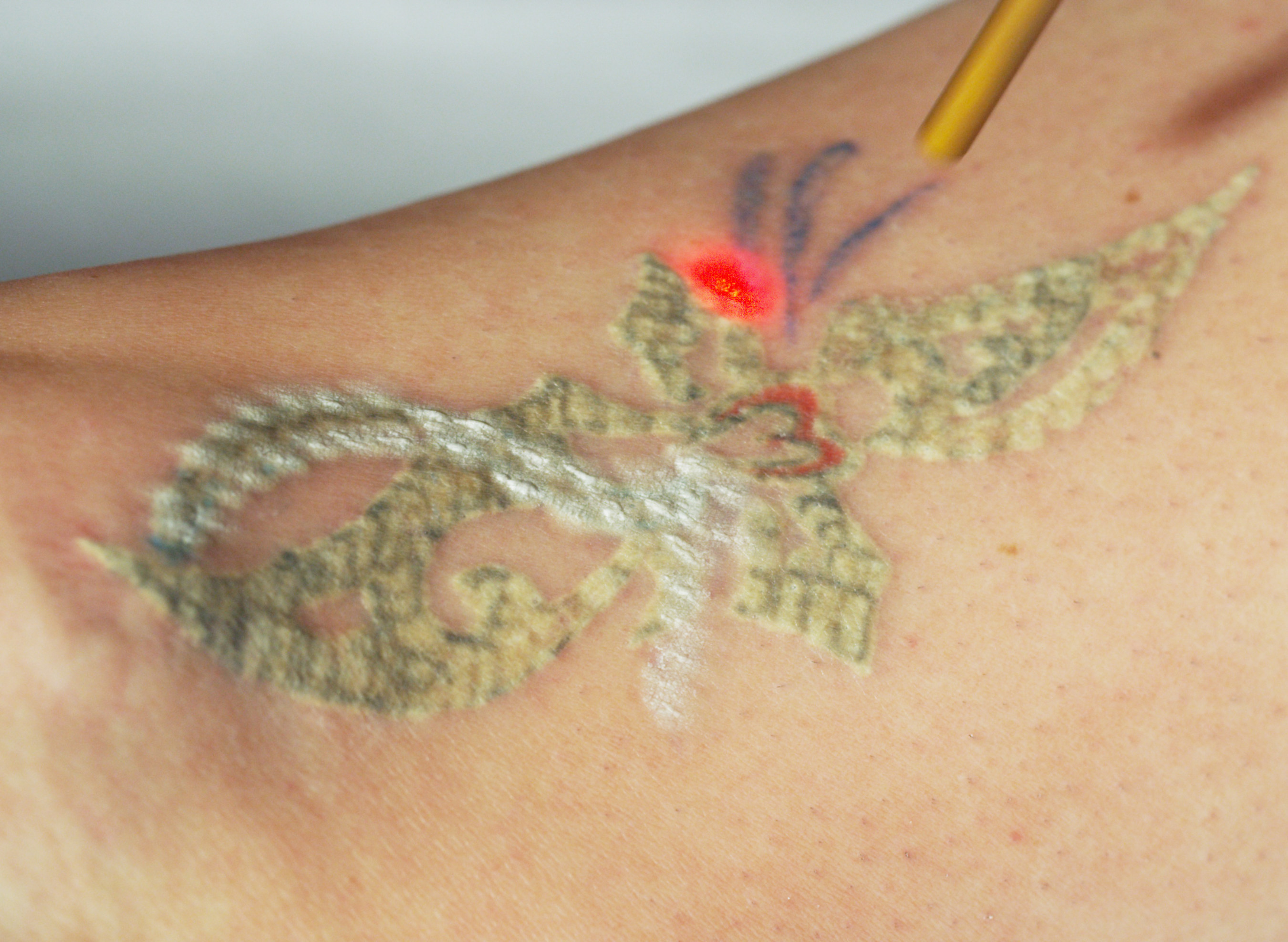 Renew MediSpa Is The First Clinic To Offer Multicolored Laser Tattoo Removal  In New Hampshire Featuring The Astanza Trinity