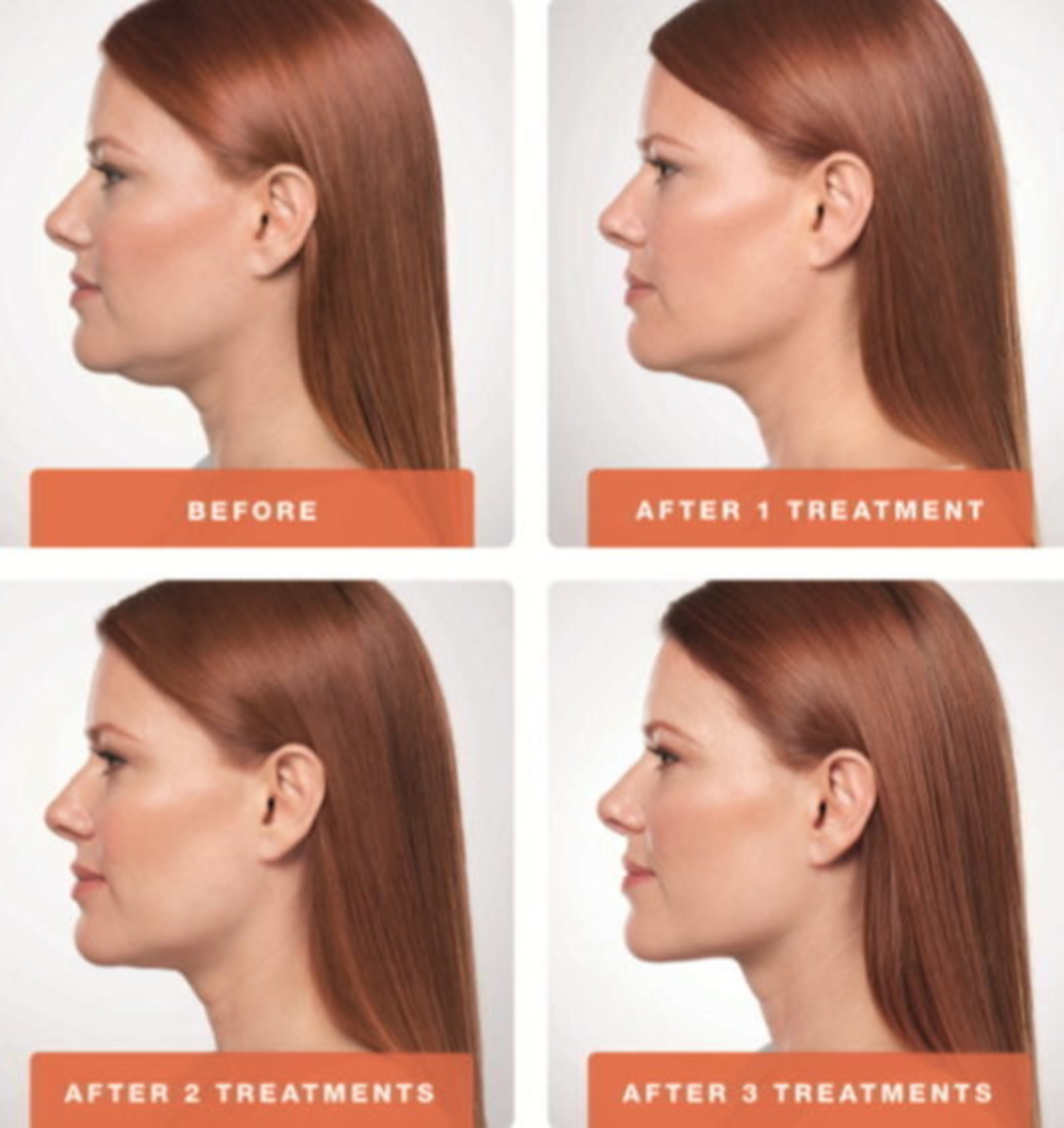 Kybella Treatment Before and After. The top picture is (2) treatments. The bottom is after (4) treatments.