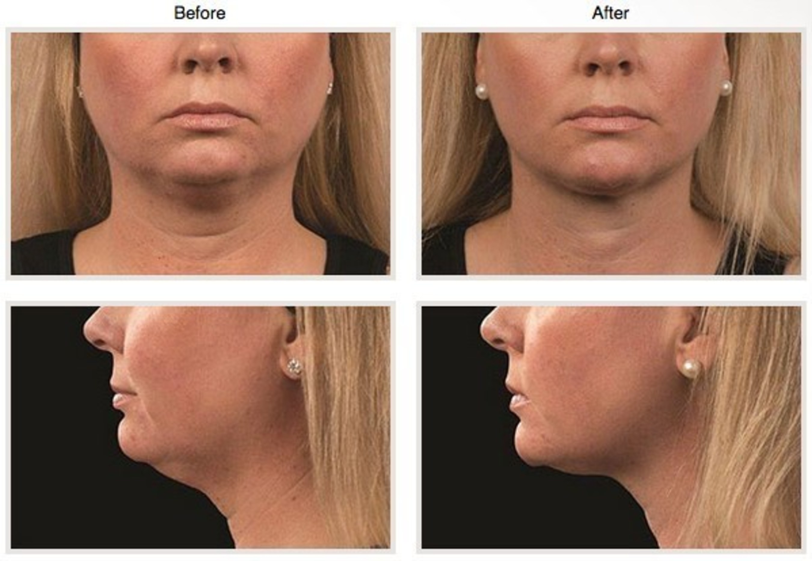CoolMini™ CoolSculpting for Double Chins