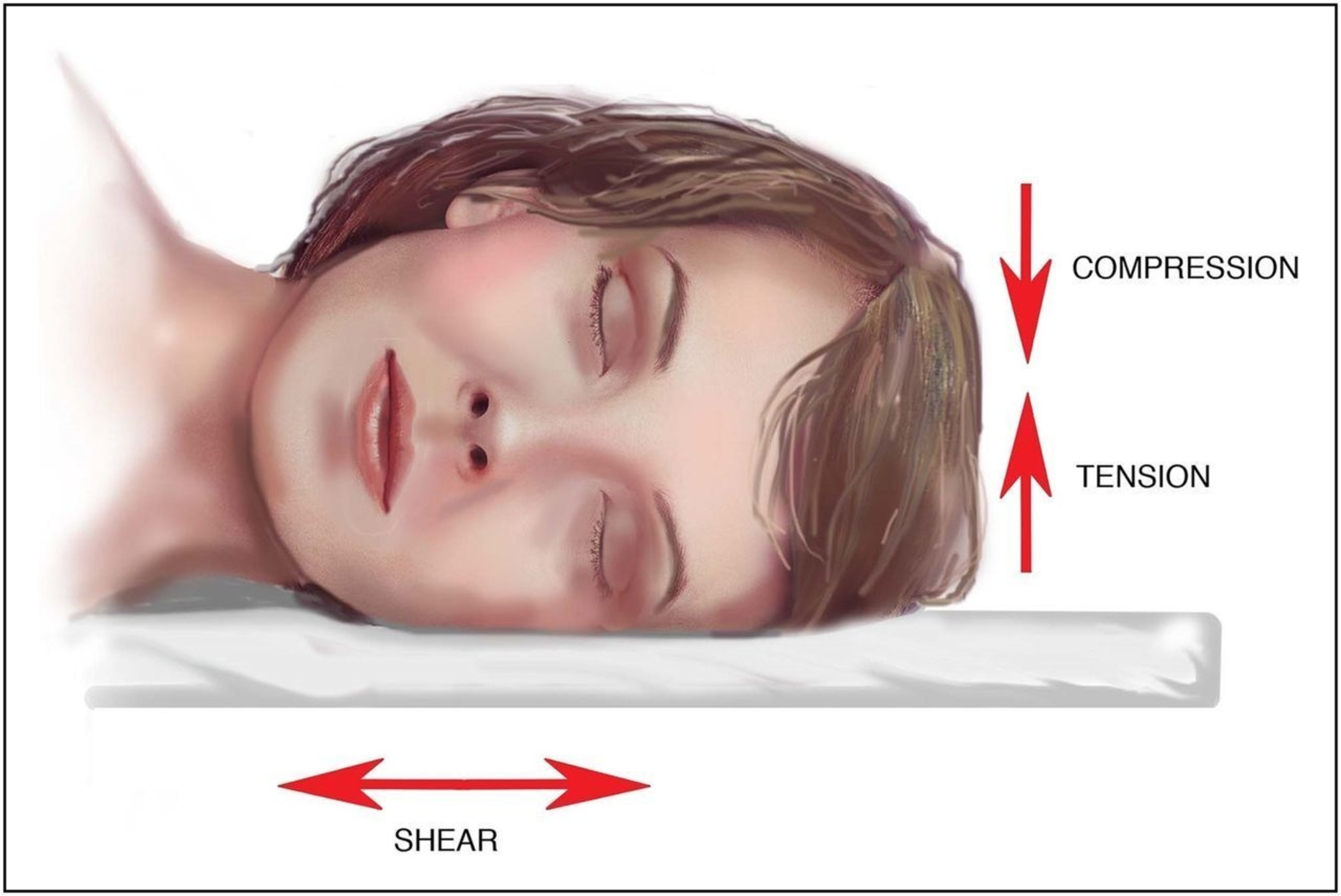 External forces (including compression, tension, and shear) act on facial tissue in stomach or side sleep positions.
