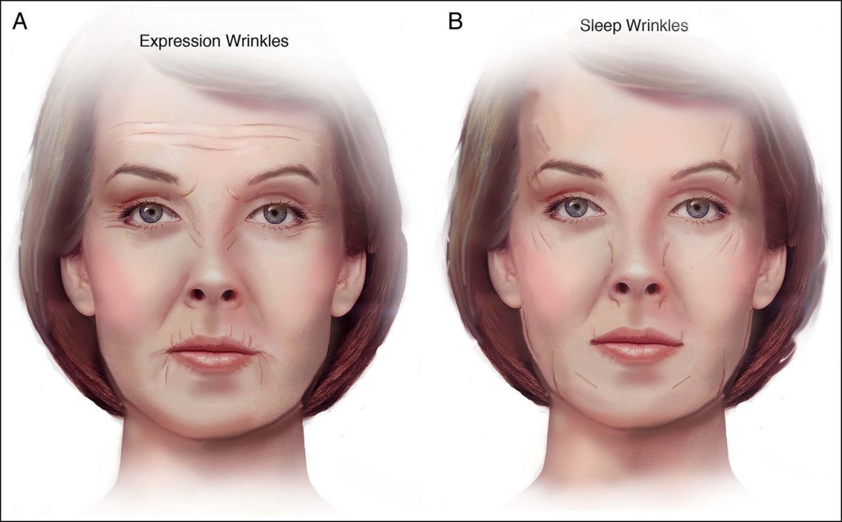 (A) Common expression wrinkles. (B) Common sleep wrinkles.