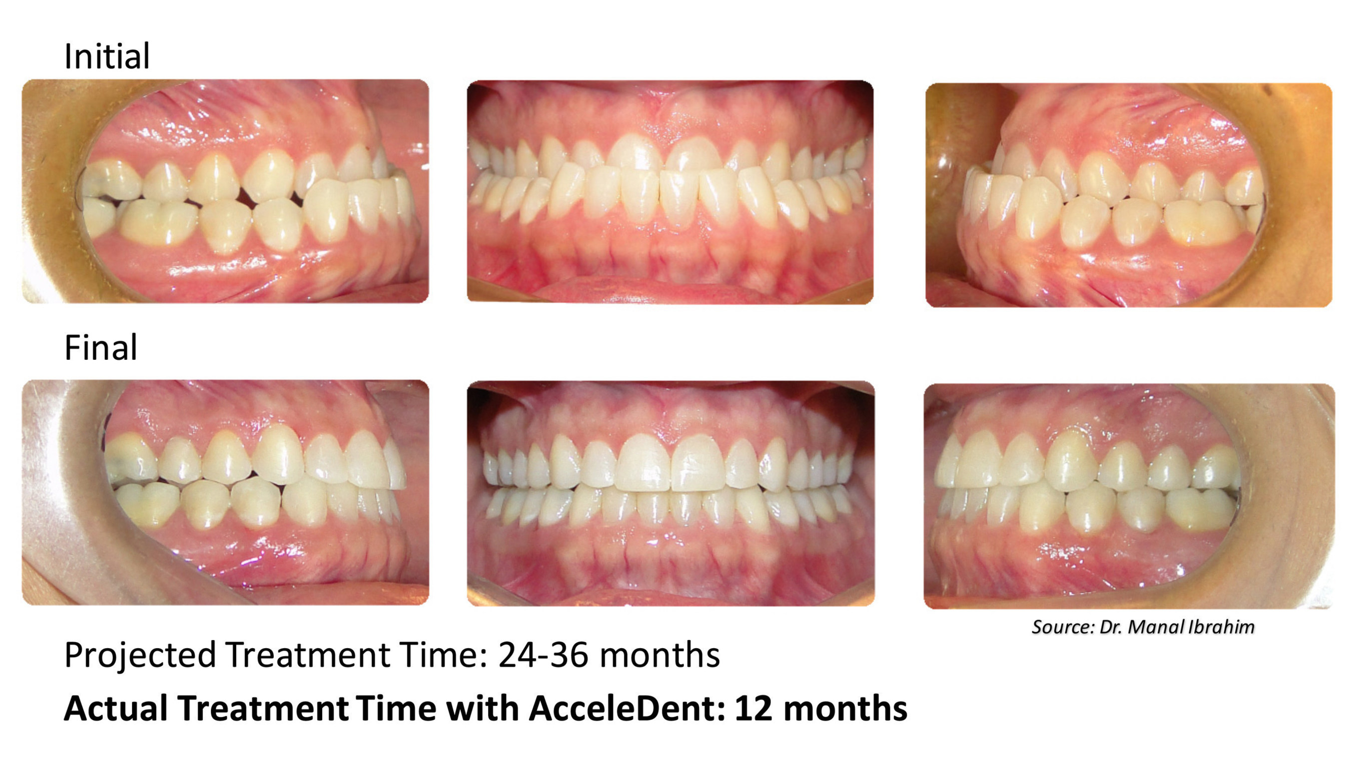 Dr. Manal Ibrahim of Innovative Orthodontic Centers in Naperville, Illinois, accelerated the treatment of this 43-year-old female patient with AcceleDent, the first and only FDA-cleared vibratory device that has been clinically proven to speed up braces and aligner treatment by as much as 50 percent and reduce the discomfort associated with orthodontic treatment. The patient presented as a class III with complete anterior crossbite and bilateral posterior crossbite. She completed accelerated orthodontic...