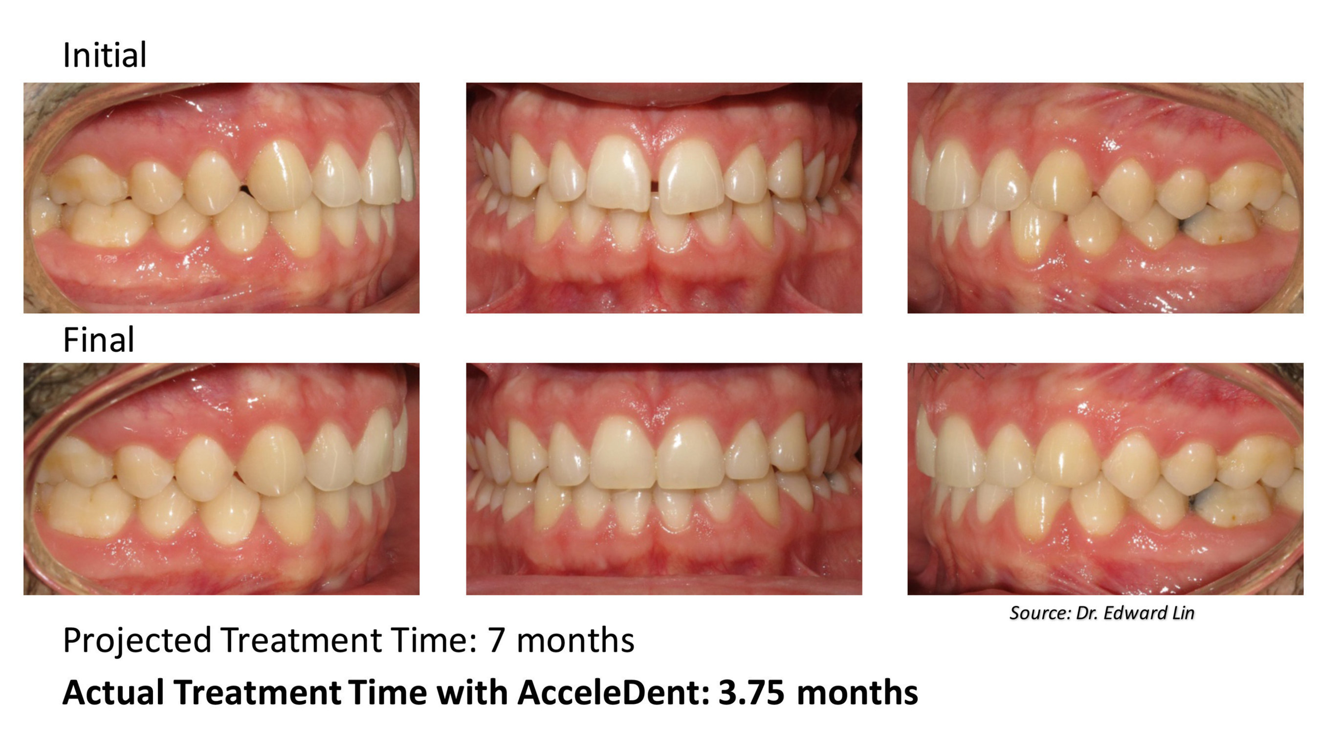 This 30-year-old male patient was treated by Dr. Edward Lin of Orthodontic Specialists in Green Bay, Wisconsin. The patient's treatment plan included aligners in conjunction with AcceleDent, the first and only FDA-cleared vibratory device that has been clinically proven to speed up braces and aligner treatment by as much as 50 percent and reduce the discomfort associated with orthodontic treatment. The patient presented as a class I with mild spacing and completed accelerated orthodontic treatment with...