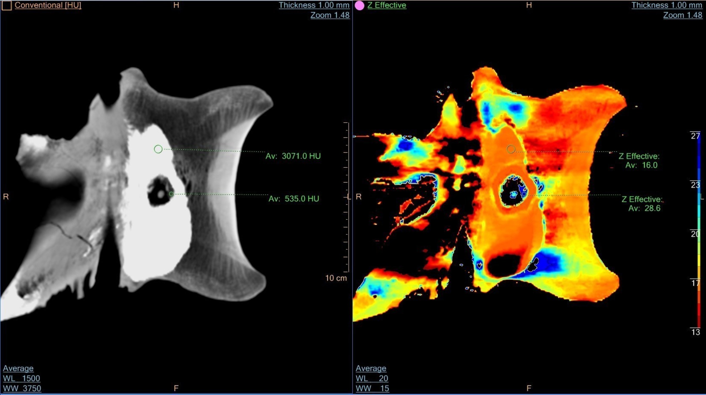 Trix tail shows color - Philips IQon was able to acquire two different X-ray energy levels in a single acquisition. Using IQon, Philips was able to identify and color-highlight bone structure, even with 'remineralized' versions of the original bones.