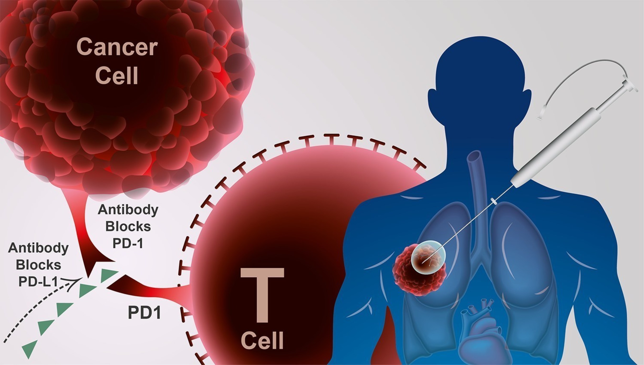 Cryoablation combined with immunotherapy enhances the anti-cancer immune response
