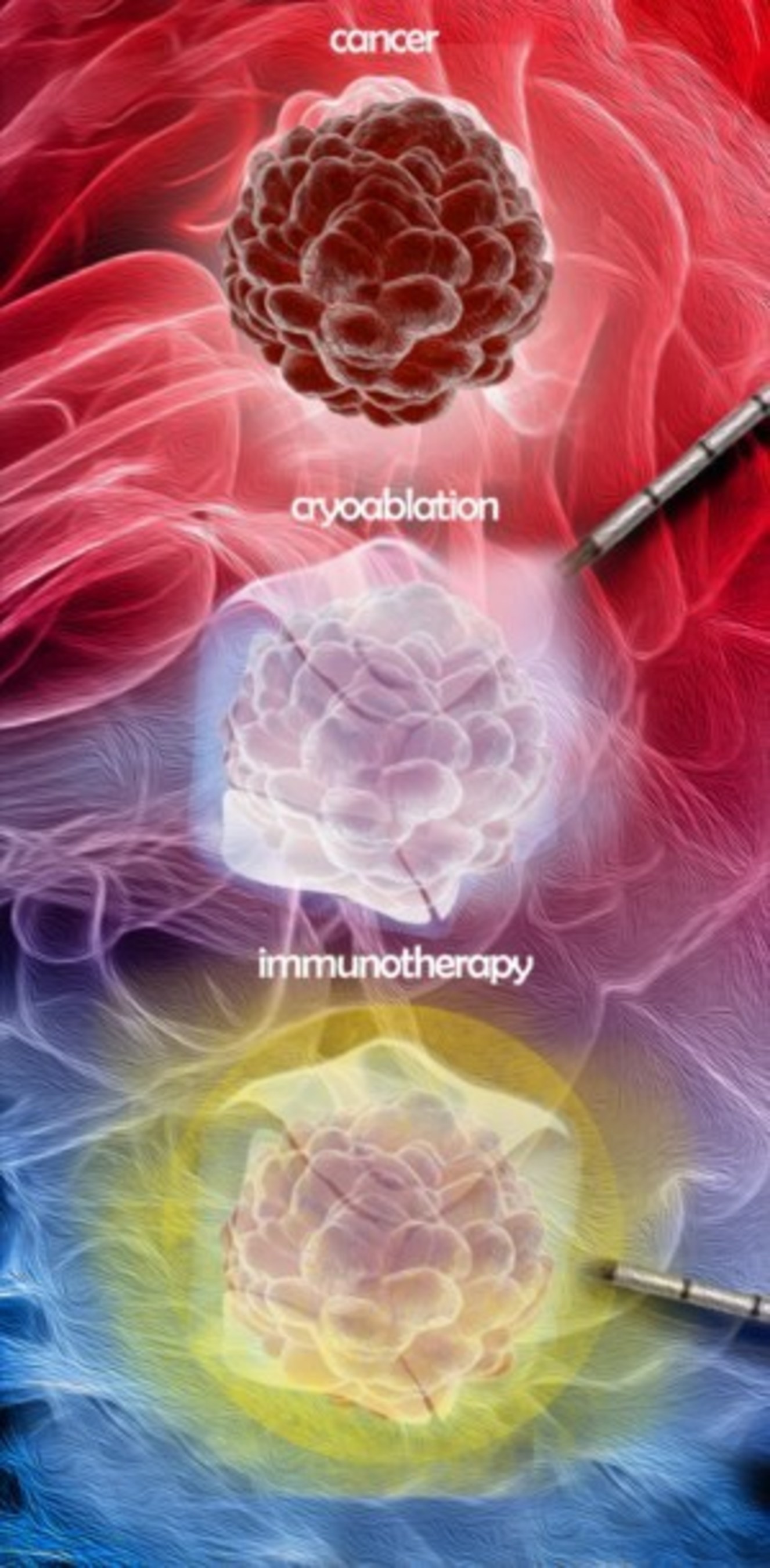 Cryoablation Immunotherapy
