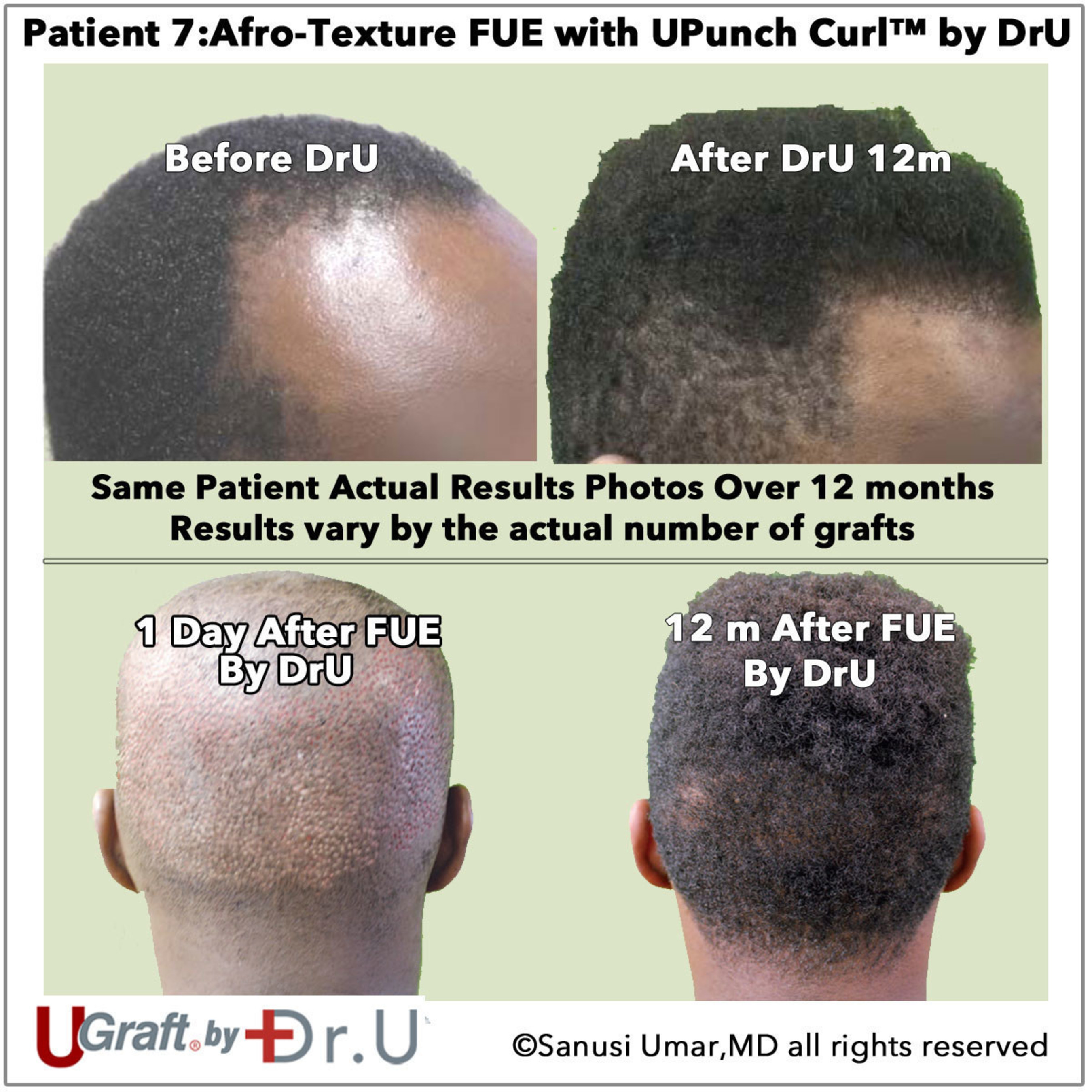 Un transplante EUF real a un paciente del Dr. Sanusi con cabello de textura afro 12 meses despues.