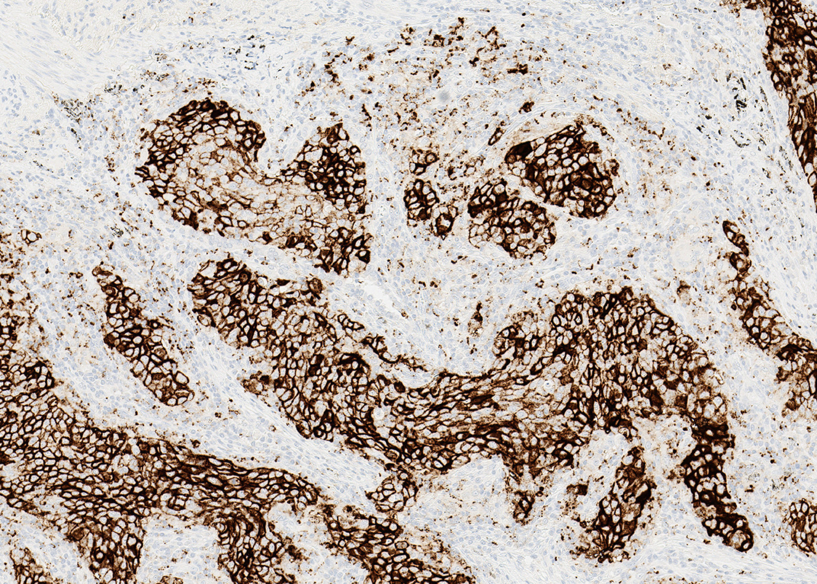 Positive NSCLC tissue stained with PD-L1 (SP142) assay, 10x