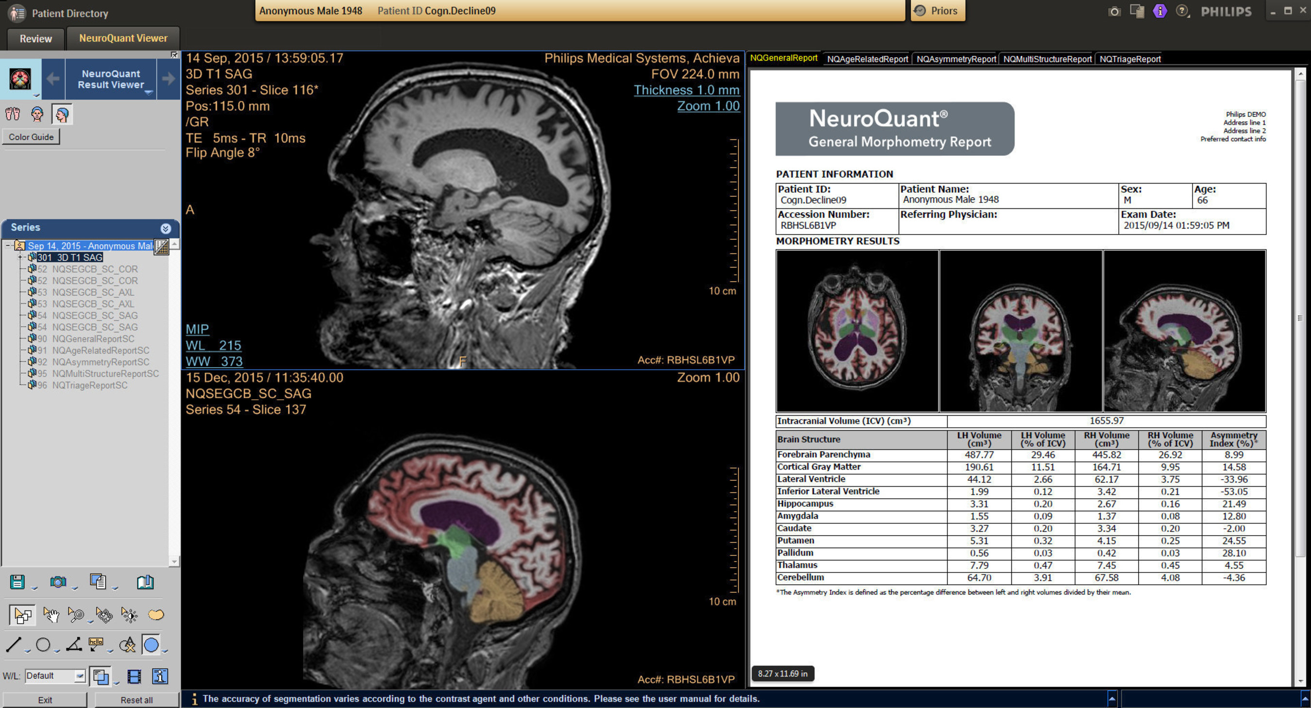 Another feature of IntelliSpace Portal 9.0 is the inclusion of the NeuroQuant(R) application (Cortechs Labs, Inc.), which enables clinicians to objectively quantify brain atrophy.