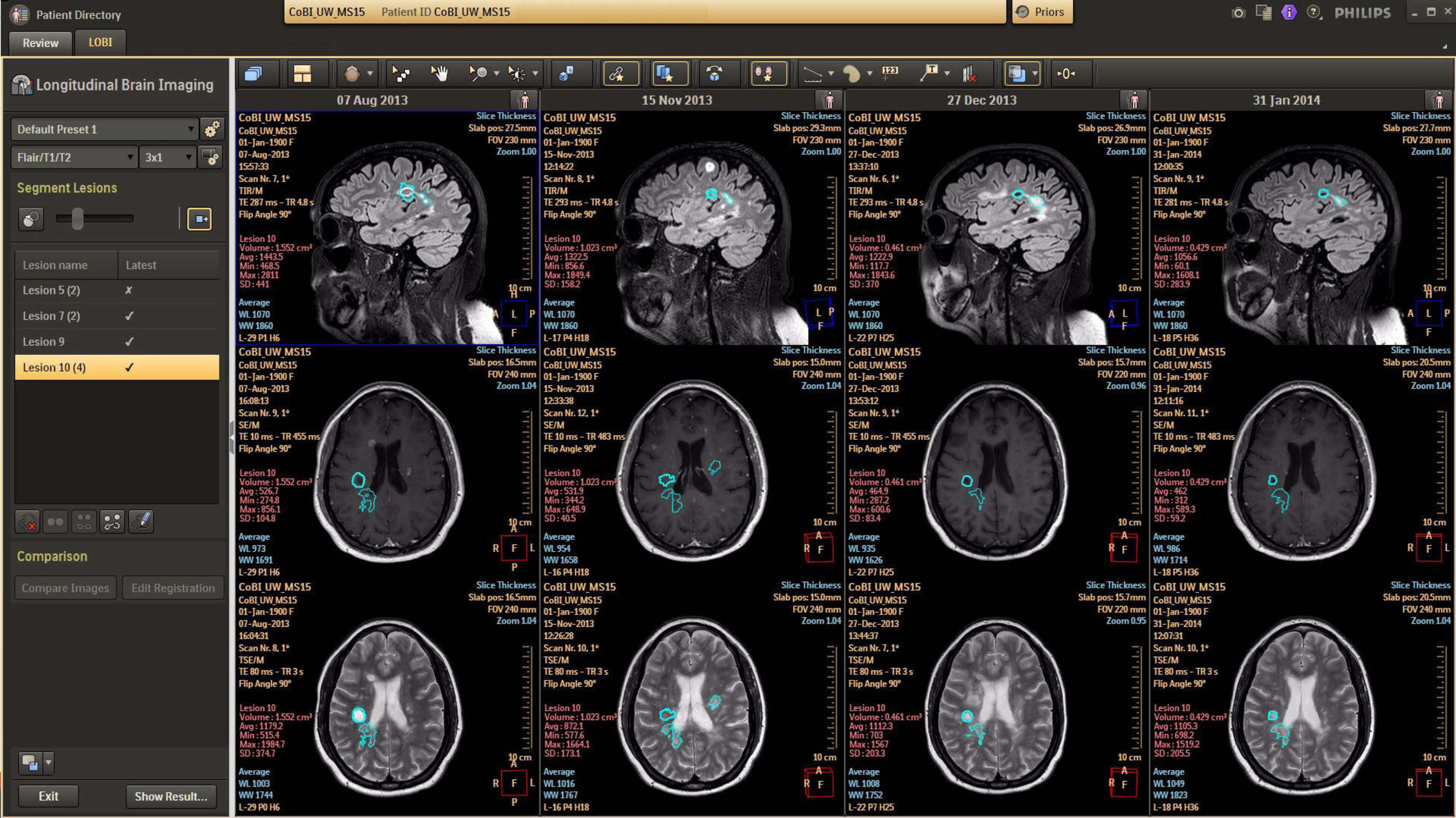 IntelliSpace Portal offers Longitudinal Brain Imaging (LoBI1*), an application that has been optimized for the interpretation of brain MRI scan and aims to facilitate the longitudinal evaluation of neurological disorders helping clinicians to monitor disease progression. *Pending 510(k), not available for sale in the United States.
