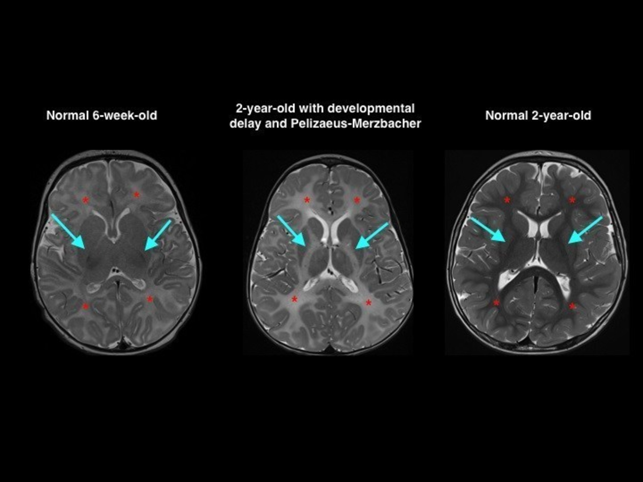 Many features of children's brains are age-specific such as the adding of myelin to nerve fibers. On these axial T2-weighted MRI scans, the addition of myelin makes the white matter appear darker over time. Comparing the normal 6-week-old with the normal 2-year-old, the white matter is much darker in the 2-year-old, both in the deep regions of the brain (shown by arrows) and in the white matter of the cerebral hemispheres (asterisks). The 2-year-old with developmental delay, due to Pelizaeus-Merzbacher disease, has a striking absence of myelination throughout the brain. Note the brightness at the posterior limb of the internal capsule (arrows) and in the white matter of the cerebral hemispheres (asterisks). This myelination pattern is much closer in appearance to that of the normal 6-week-old than that of a normal 2-year-old but is sometimes missed because the pattern is symmetrical. Providing reference images can help clinicians not accustomed to looking at pediatric brain scans identify the abnormality.