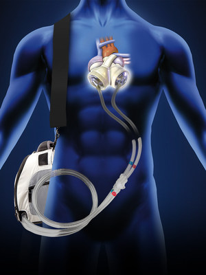 Brothers Stan and Dominique Larkin both received the SynCardia Total Artificial Heart to save them from life-threatening genetic heart disease. One is home with his donor heart; the other is home with his SynCardia Heart waiting for his donor heart.