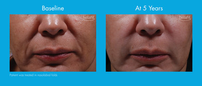 Patients who have experienced dermal filler fatigue or are frustrated with the recurring costs associated with filler treatments and time spent at appointments may consider Bellafill for natural-looking and long-lasting correction