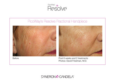 Syneron Candela Announces the Launch of PicoWay Resolve at EADV