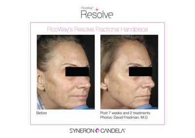 Syneron Candela Announces the Launch of PicoWay Resolve at EADV