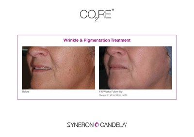 CO2RE Wrinkle and Pigmentation Treatment