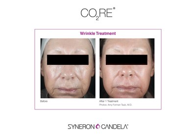 CO2RE Wrinkle Treatment