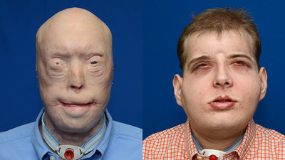 Patrick Hardison: before and after face transplant