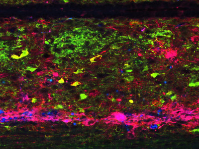This microscopic image shows the development of abnormal nervous circuity in the spinal tissues of mouse models with high thoracic spinal injury. The aberrant circuitry causes responses that extend beyond thoracic spinal segments. In this image, fluoresced developing interneurons glow almost like clusters of stars in the night sky. As the circuitry expands, it activated by an interaction with the spleen. This helps trigger a dangerous anti-inflammatory and immune suppressive reflex. Researchers report their results April 18 in the journal Nature Neuroscience.Image credit: Cincinnati Children's
