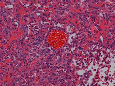 The microscopic image above shows tissues from an adult mouse lung in which the FOXF1 gene has been deleted for two weeks in endothelial cells. The lungs undergo  thickening of tiny air sacs called alveolar and show congestion and severe inflammation. This leads to the development of pulmonary hemorrhaging and fibrosis in the lungs and death. In laboratory tests, an experimental compound being developed by researchers at Cincinnati Children's Hospital Medical Center stabilizes FOXF1 and allows the lungs to recover. Researchers report their findings April 19 in the journal Science Signaling. (Image credit Cincinnati Children's)