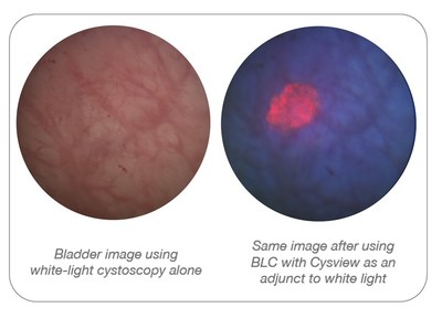 White-light cystoscopy (WLC) compared to blue-light cystoscopy (BLC) with Cysview