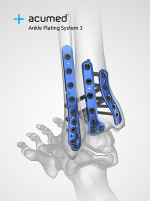 The Acumed Ankle Plating System 3is composed of seven plate families that span the lateral, medial, and posterior malleoli