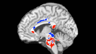 This image of a concussion patient's brain shows low FA areas (red) probably signifying injured white matter, plus high FA areas (blue) perhaps indicating more efficient white-matter connections  compensating for concussion damage. A large amount of high FA predicts recovery from concussion.
