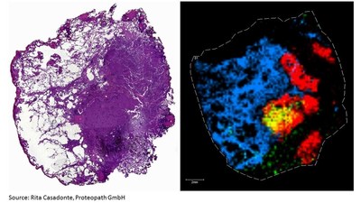 HE Stain of Lung Carcinoma (left) and MALDI Molecular Image of the Lung Carcinoma (right). Source: Rita Casadonte, Proteopath GmbH, Trier, Germany