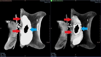 Comparison of a conventional CT image (left) with the image obtained with the IQon (right). The observed 'density' in the conventional CT image - caused by the pyrite infill visible between the spinal canal and the main body of the vertebra - is removed in the IQon Spectral CT image, revealing not only the bone structure in the affected region (red arrows), but also the structure of the pyrite infill itself (blue arrows).