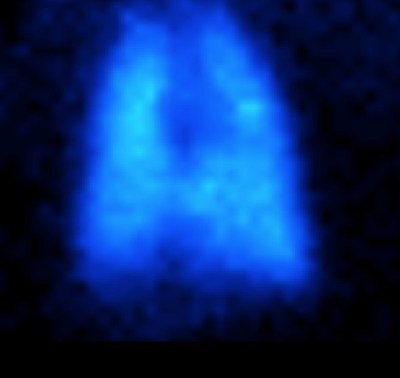 Image 1 - 2-D Planar image of technetium-labeled KL4 surfactant distributed throughout primate lung.