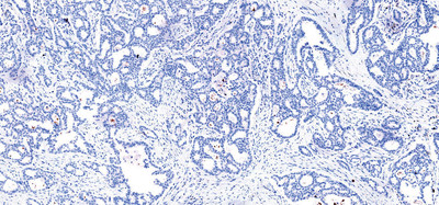 Negative case of lung tissue stained for ALK with VENTANA ALK (D5F3) CDx Assay