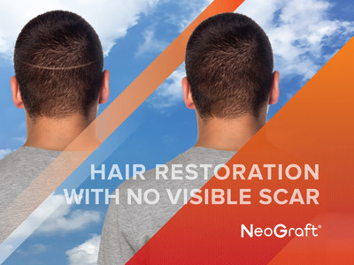 NeoGraft(R) is the highest rated hair transplant surgery on RealSelf.com NeoGraft(R) is the first FDA-cleared follicular unit harvesting and implantation system that extracts individual hair follicles. Compared to the traditional strip method, a NeoGraft(R) procedure is minimally invasive, requires significantly less recovery time, and has 20 years of clinically proven results. NeoGraft(R) Solution's vision is to be the world leader in hair restoration, supplying the latest innovations in technology, education, and patient care.