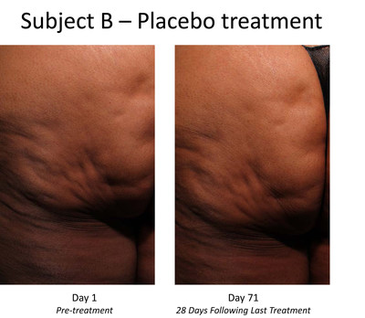 Pre- and post-treatment photos of placebo-treated subject