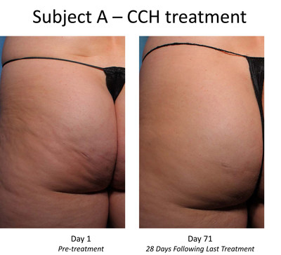 Pre- and post-treatment photos of CCH-treated subject