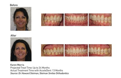 Karen Morris used AcceleDent in conjunction with her orthodontic treatment to correct crowding and a deep overbite. Her orthodontist, Dr. Howard Steiman of Steiman Smiles Orthodontics in Ajax, Ontario, recommended that she use AcceleDent to reduce the treatment time from an estimated 24 months to 13 months and to alleviate pain during treatment. AcceleDent is an FDA-cleared vibratory orthodontic device used in conjunction with braces or aligners to speed up orthodontic treatment by as much as 50 percent.