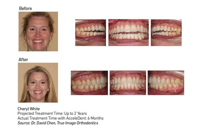 A professional singer and music teacher, Cheryl White completed orthodontic treatment with AcceleDent in just six months to correct an open bite. Her orthodontist, Dr. David Chen of True Image Orthodontics in Cypress, Texas, said that correction of an open bite can take up to two years. AcceleDent is an FDA-cleared vibratory orthodontic device that works in conjunction with braces or aligners to speed up orthodontic treatment by as much as 50 percent.